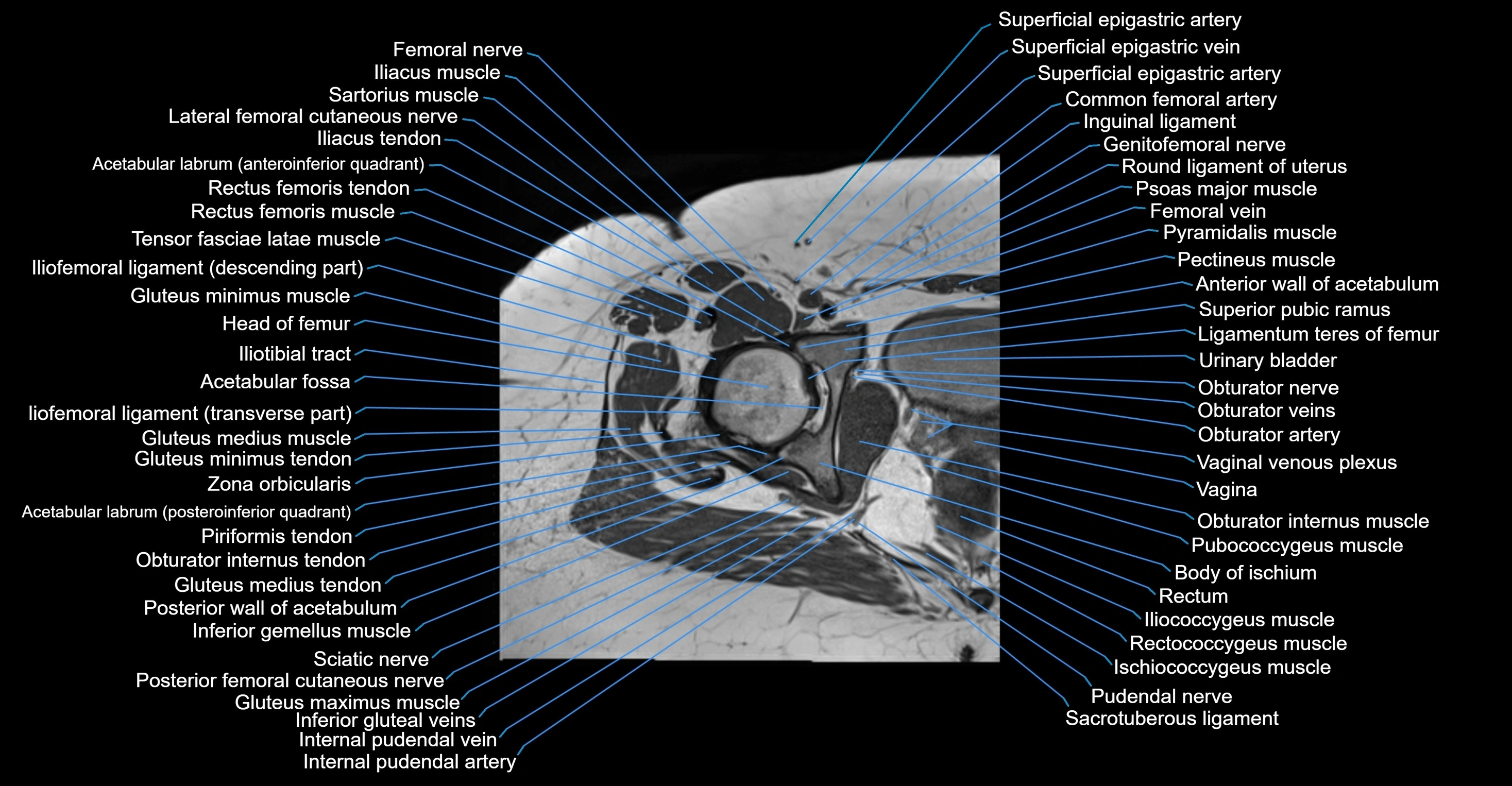 MRI hip axial cross sectional anatomy 3T 3D  radiology  anatomy image-img-00001-00038.webp